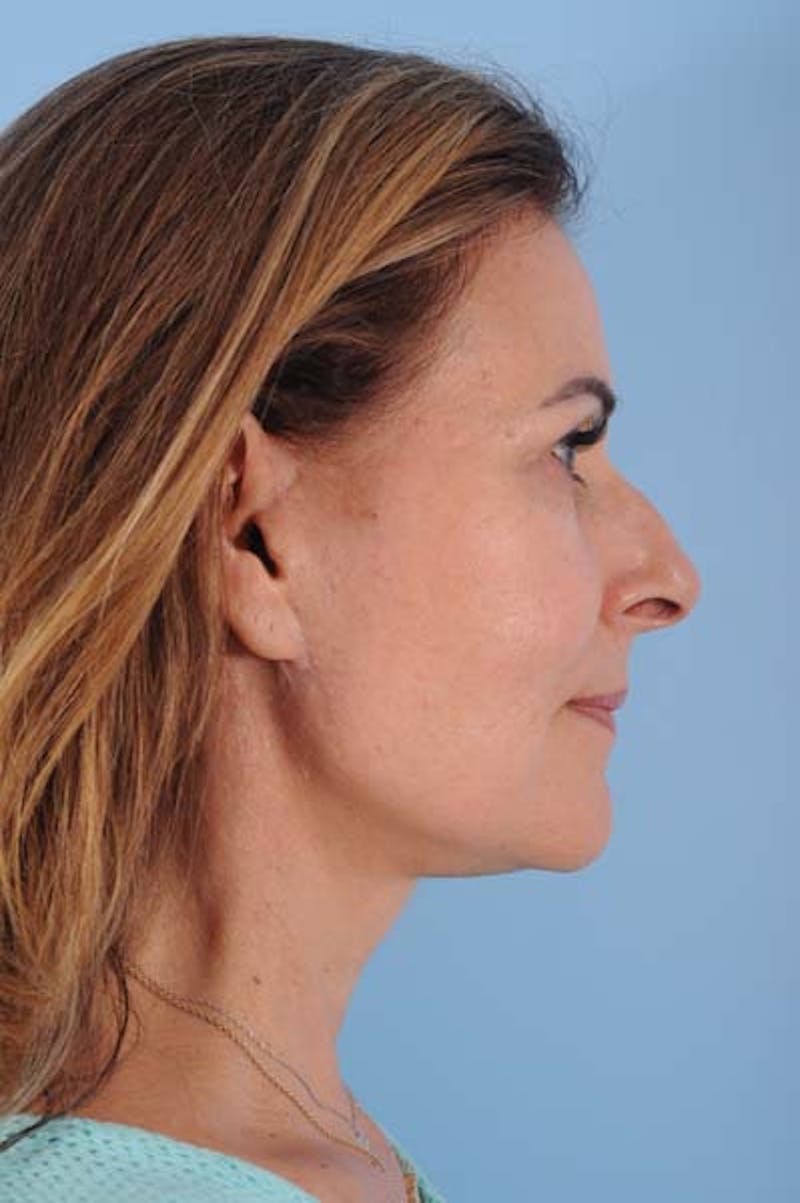 Neck Lift Before & After Gallery - Patient 421465 - Image 8