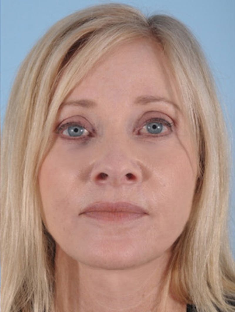 Facelift Before & After Gallery - Patient 143241 - Image 2