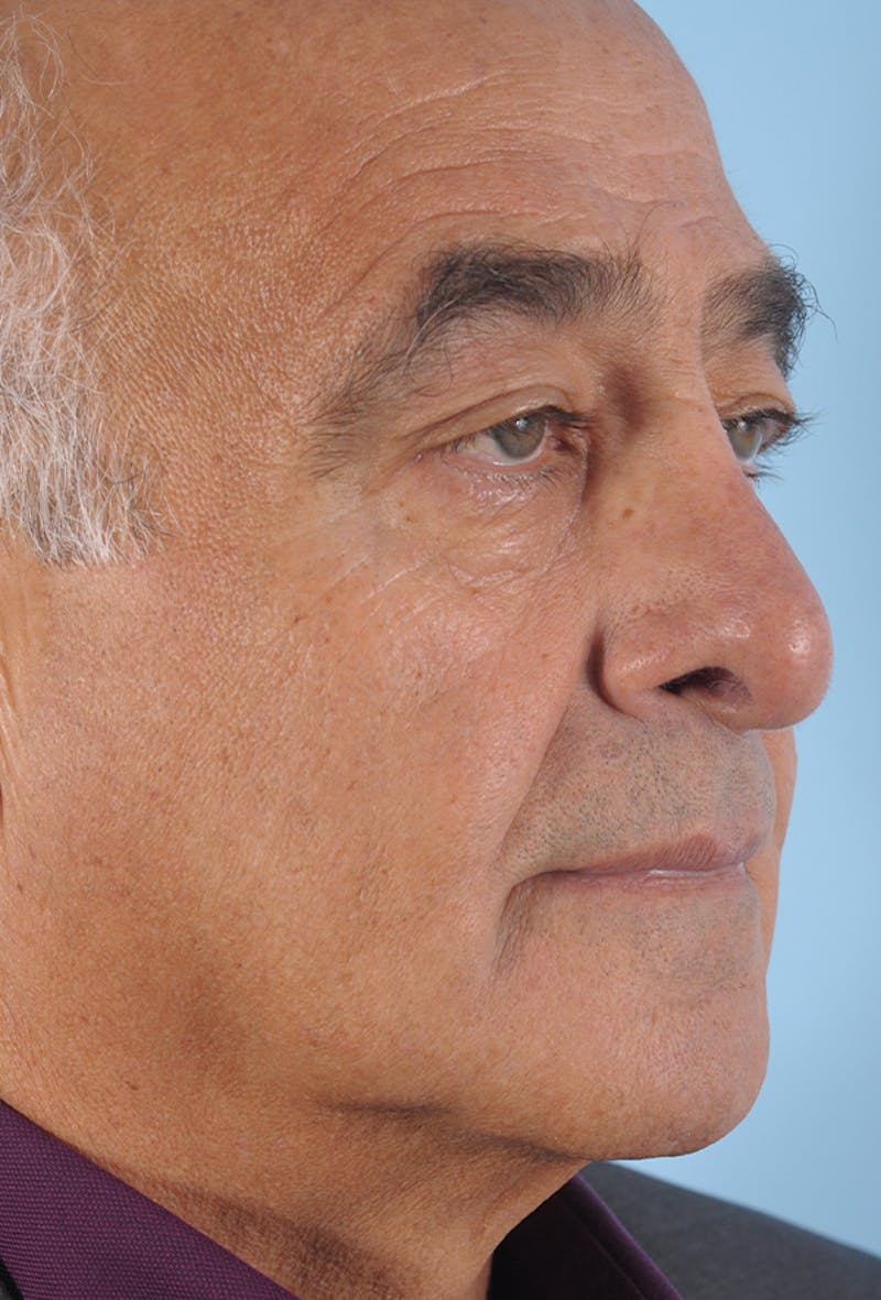 Upper Blepharoplasty Before & After Gallery - Patient 165838 - Image 5