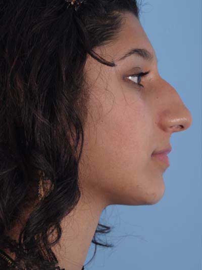 Rhinoplasty Before & After Gallery - Patient 225360 - Image 7