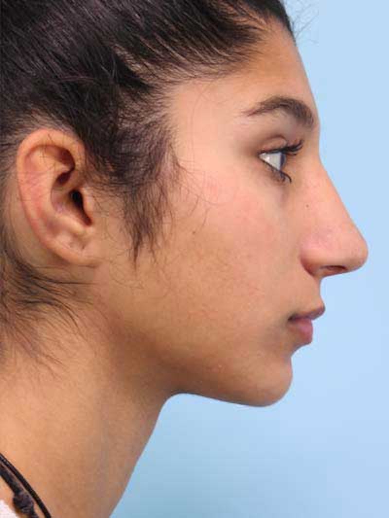 Rhinoplasty Before & After Gallery - Patient 225360 - Image 8