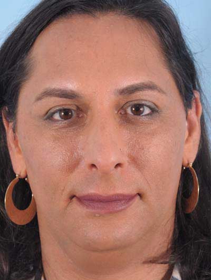 Rhinoplasty Before & After Gallery - Patient 957110 - Image 5