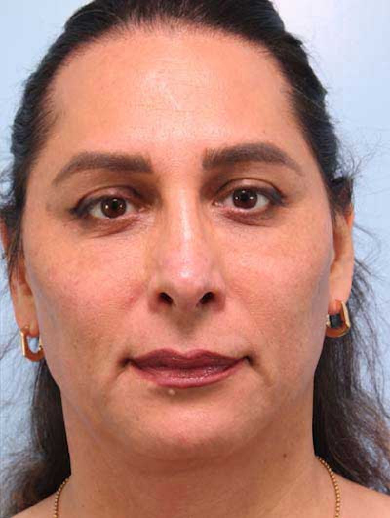 Rhinoplasty Before & After Gallery - Patient 957110 - Image 6