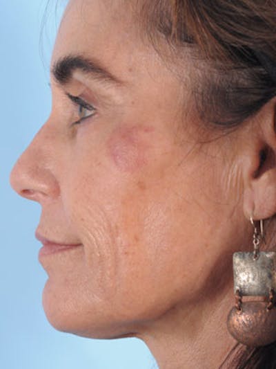 Neck Lift Before & After Gallery - Patient 347893 - Image 1