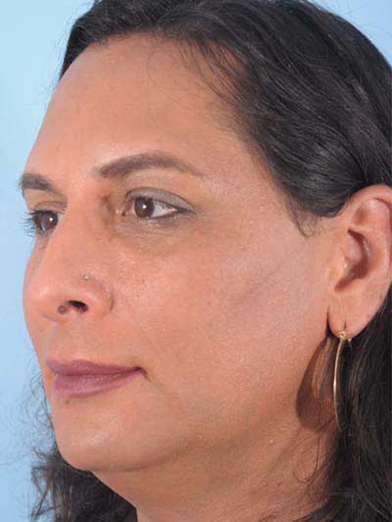 Rhinoplasty Before & After Gallery - Patient 957110 - Image 7