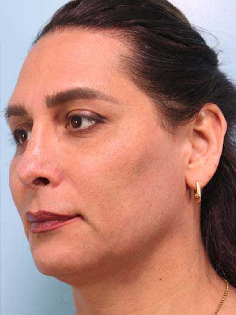 Rhinoplasty Before & After Gallery - Patient 957110 - Image 8