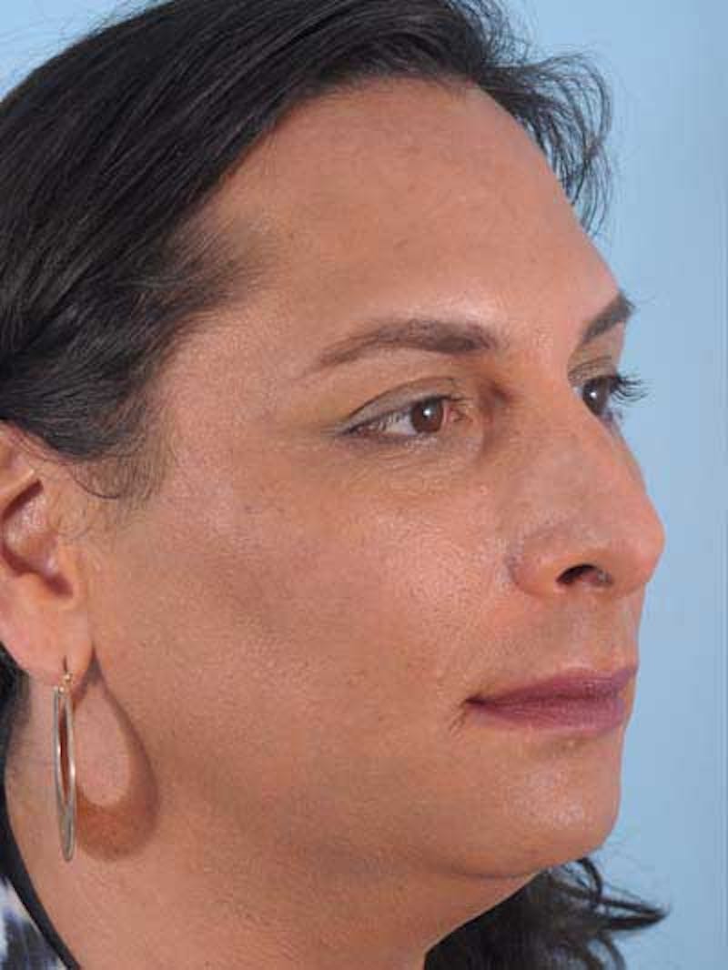 Rhinoplasty Before & After Gallery - Patient 957110 - Image 9