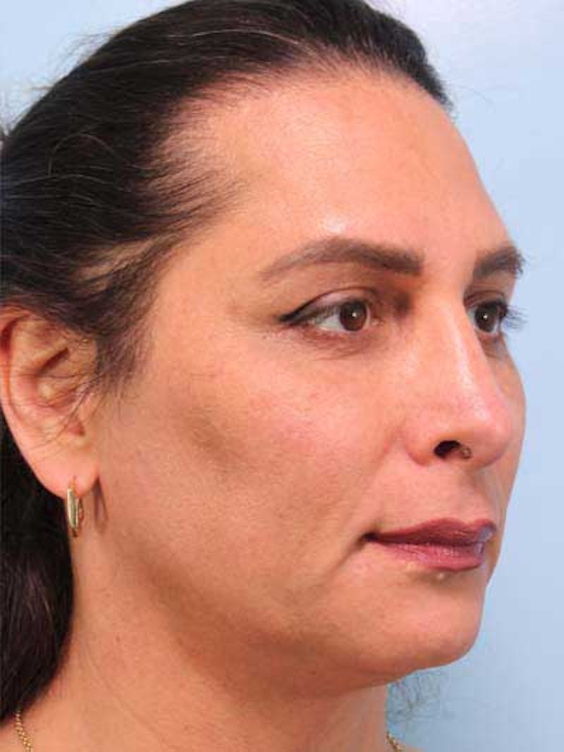 Rhinoplasty Before & After Gallery - Patient 957110 - Image 10