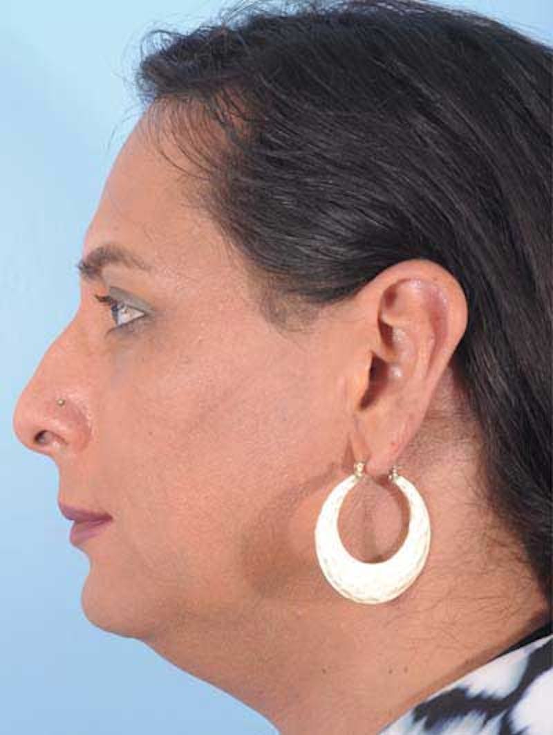 Rhinoplasty Before & After Gallery - Patient 957110 - Image 3