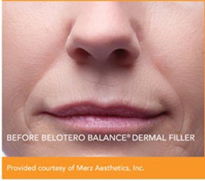 Dermal Fillers Before & After Gallery - Patient 156055 - Image 1