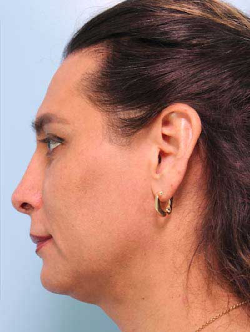 Rhinoplasty Before & After Gallery - Patient 957110 - Image 4