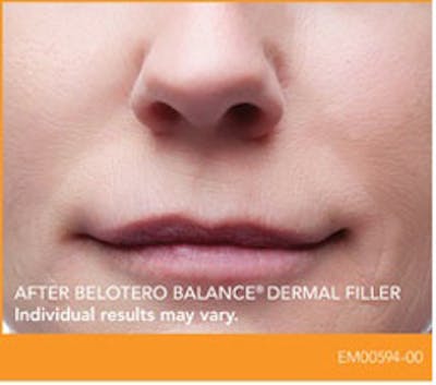 Dermal Fillers Before & After Gallery - Patient 156055 - Image 2