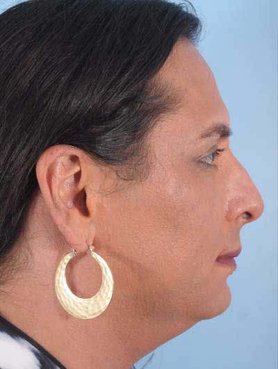 Rhinoplasty Before & After Gallery - Patient 957110 - Image 1