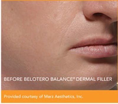 Dermal Fillers Before & After Gallery - Patient 365986 - Image 1
