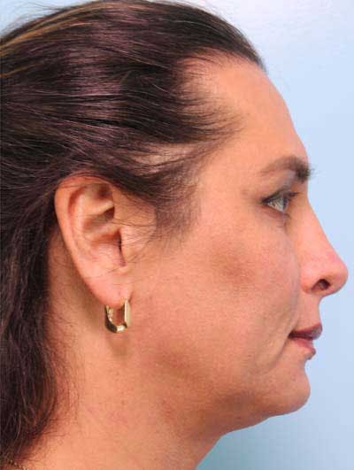 Rhinoplasty Before & After Gallery - Patient 957110 - Image 2
