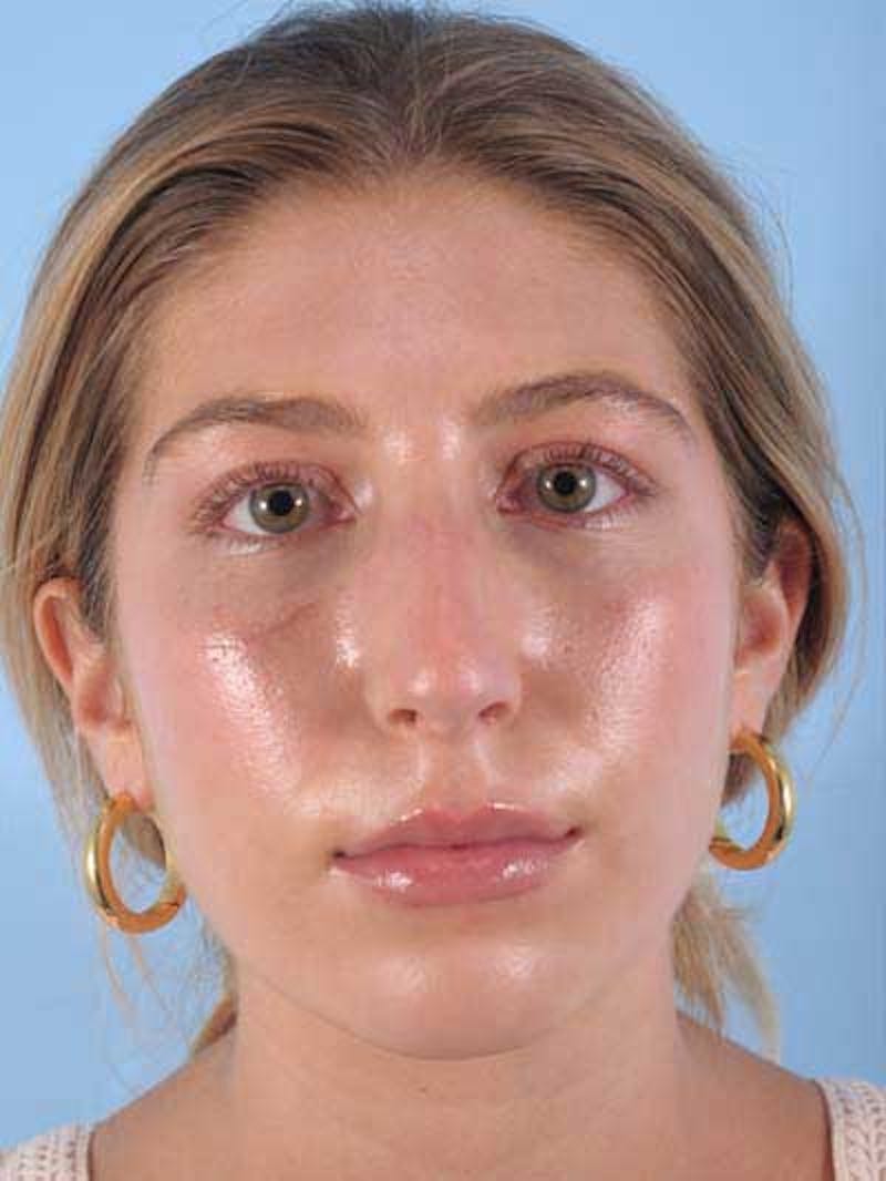 Rhinoplasty Before & After Gallery - Patient 277111 - Image 5