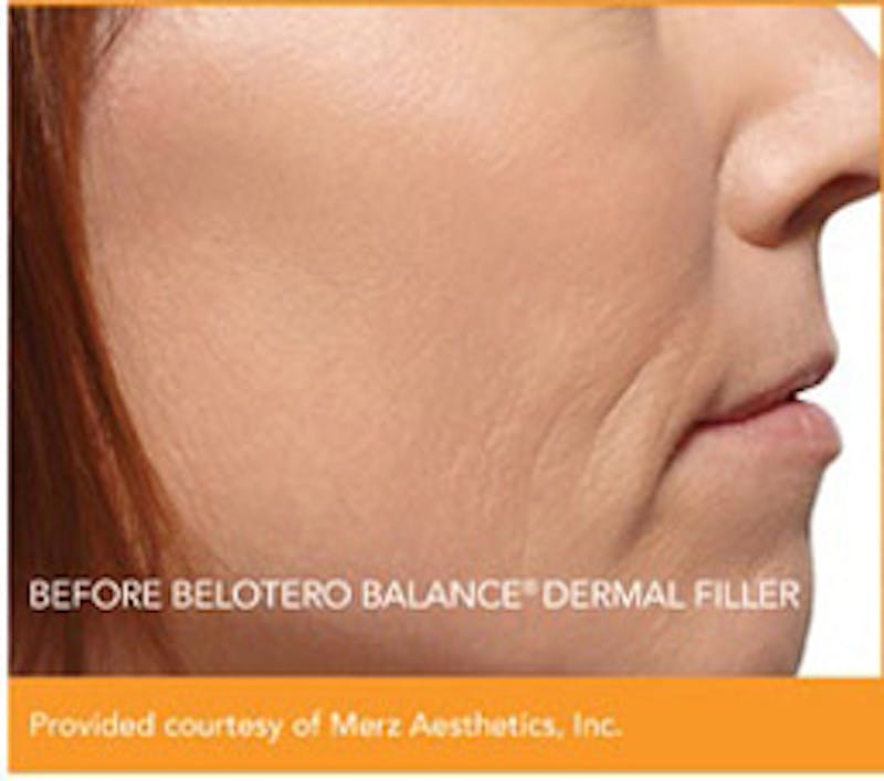 Dermal Fillers Before & After Gallery - Patient 915211 - Image 1
