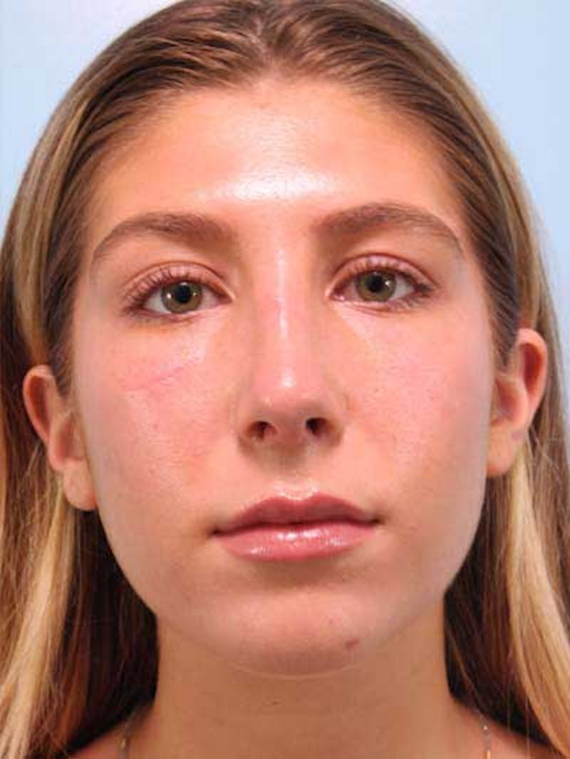 Rhinoplasty Before & After Gallery - Patient 277111 - Image 6