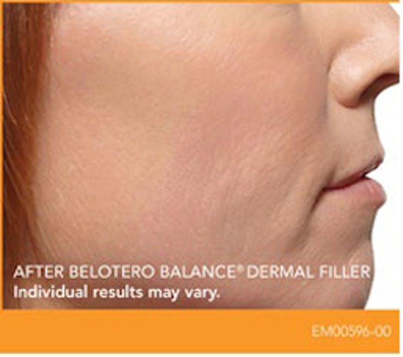 Dermal Fillers Before & After Gallery - Patient 915211 - Image 2