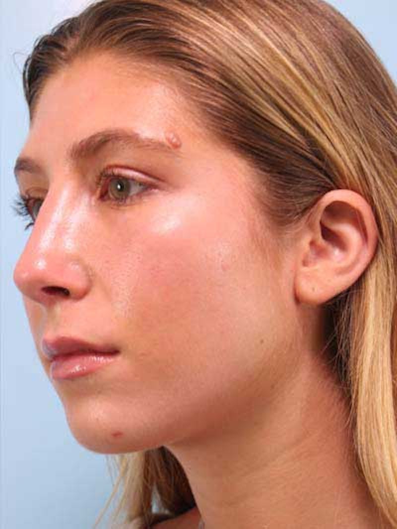 Rhinoplasty Before & After Gallery - Patient 277111 - Image 8