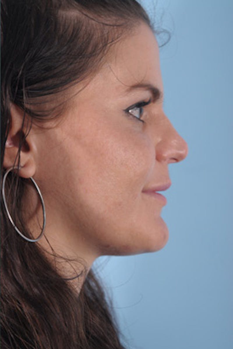 Neurotoxins Before & After Gallery - Patient 231684 - Image 4