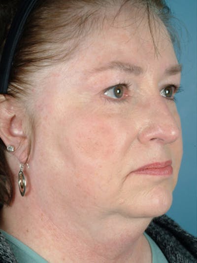 Facelift Before & After Gallery - Patient 361633 - Image 1