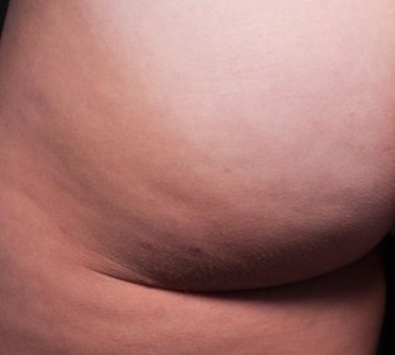 Cellfina Before & After Gallery - Patient 150528 - Image 2