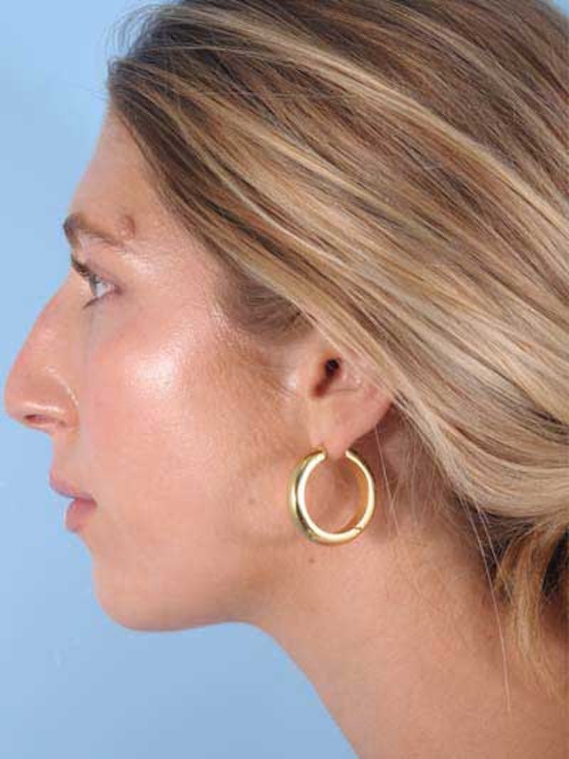 Rhinoplasty Before & After Gallery - Patient 277111 - Image 3