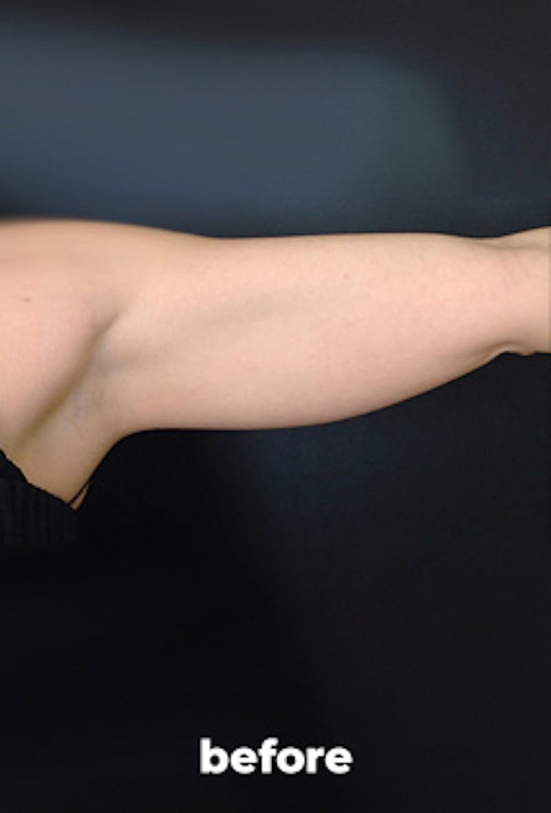 Coolsculpting Before & After Gallery - Patient 101484 - Image 1