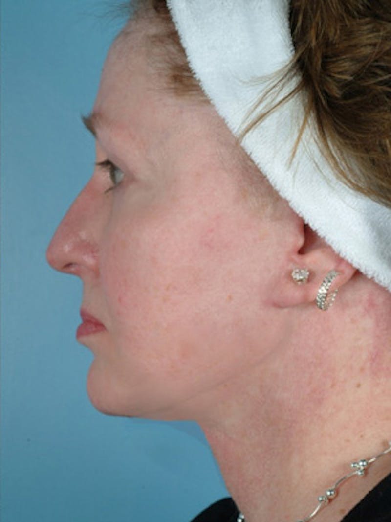 Facelift Before & After Gallery - Patient 361633 - Image 4