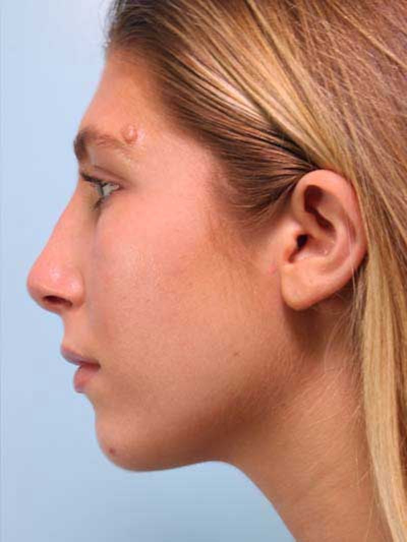 Rhinoplasty Before & After Gallery - Patient 277111 - Image 4