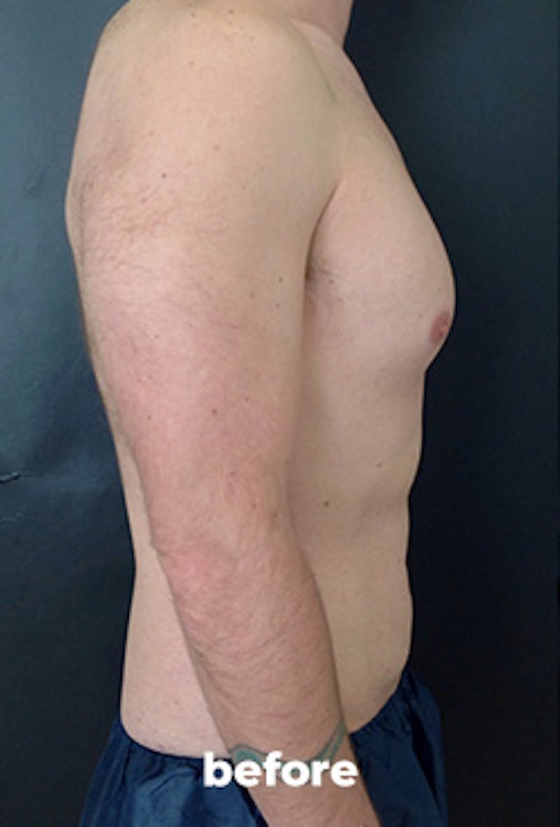 Coolsculpting Before & After Gallery - Patient 219806 - Image 3