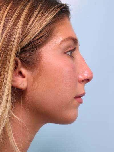 Rhinoplasty Before & After Gallery - Patient 277111 - Image 2