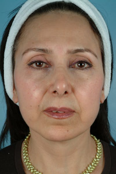 Facelift Surgery  Before & After Gallery - Patient 289412 - Image 2