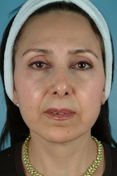Facelift Before & After Gallery - Patient 289412 - Image 2