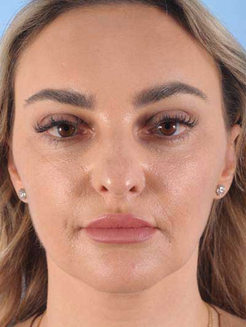 Rhinoplasty Before & After Gallery - Patient 115587 - Image 5
