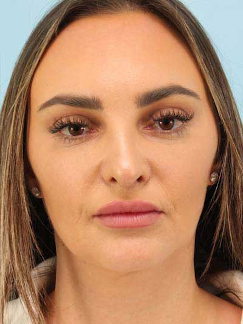 Rhinoplasty Before & After Gallery - Patient 115587 - Image 6