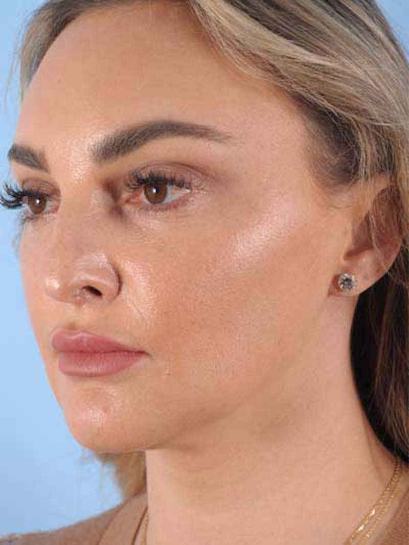 Rhinoplasty Before & After Gallery - Patient 115587 - Image 7