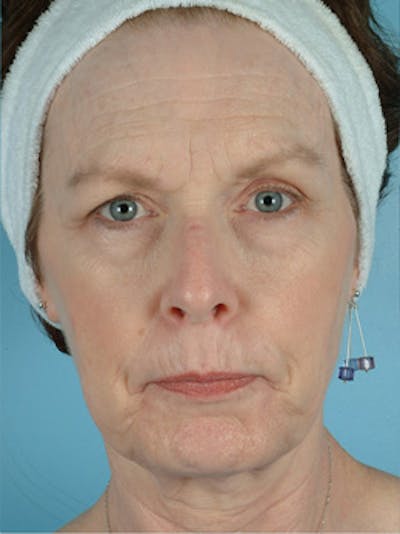 Facelift Before & After Gallery - Patient 607503 - Image 1