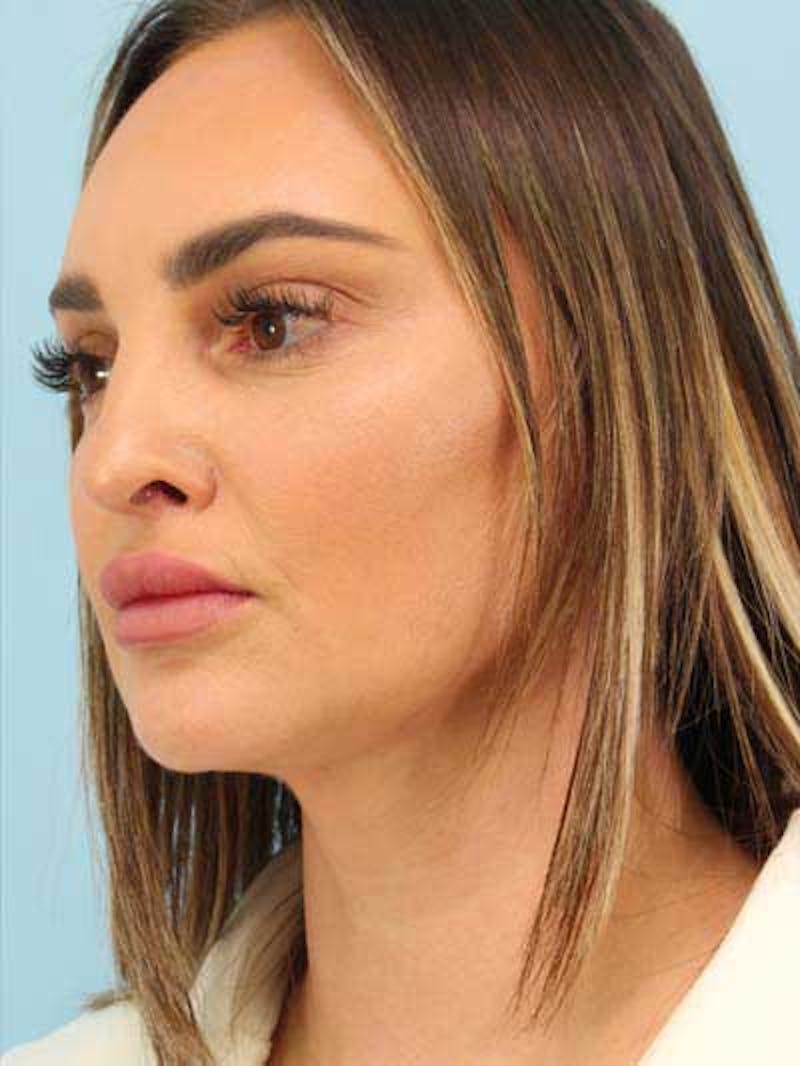 Rhinoplasty Before & After Gallery - Patient 115587 - Image 8