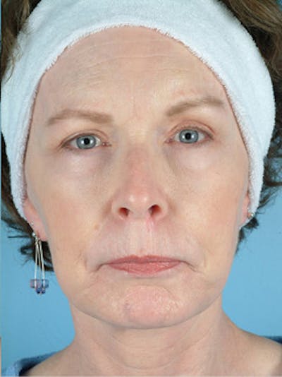 Facelift Before & After Gallery - Patient 607503 - Image 2