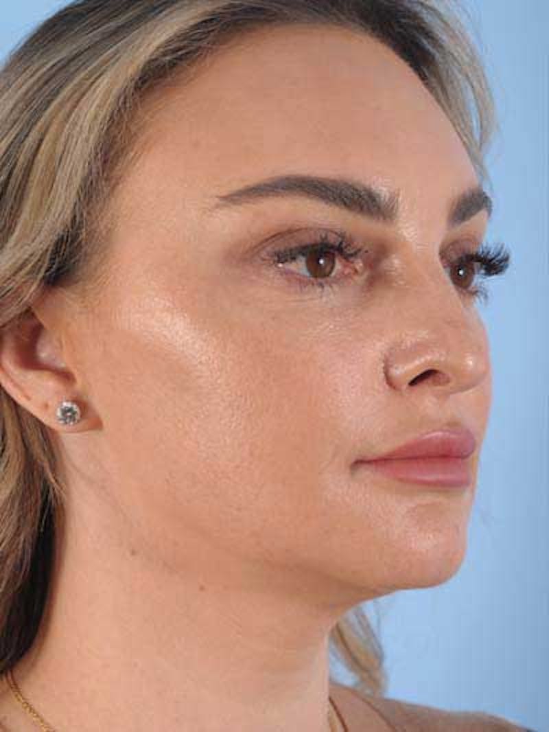 Rhinoplasty Before & After Gallery - Patient 115587 - Image 9