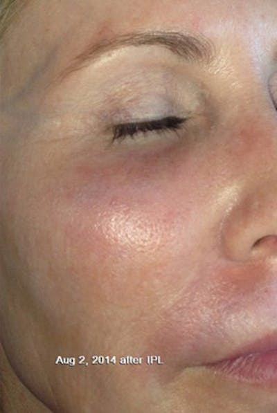 IPL Photofacial Before & After Gallery - Patient 136025 - Image 2