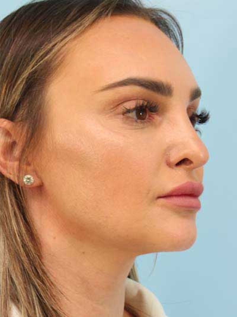Rhinoplasty Before & After Gallery - Patient 115587 - Image 10