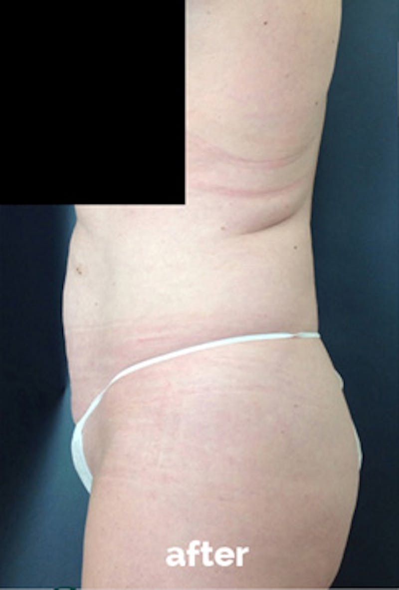 Coolsculpting Before & After Gallery - Patient 315384 - Image 4