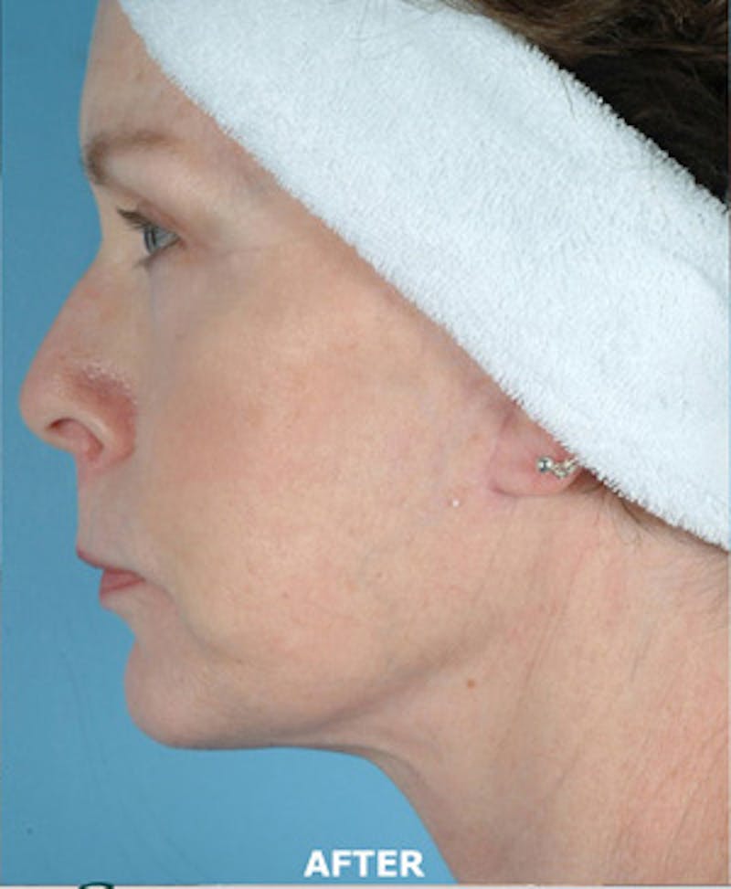 Facelift Before & After Gallery - Patient 607503 - Image 4