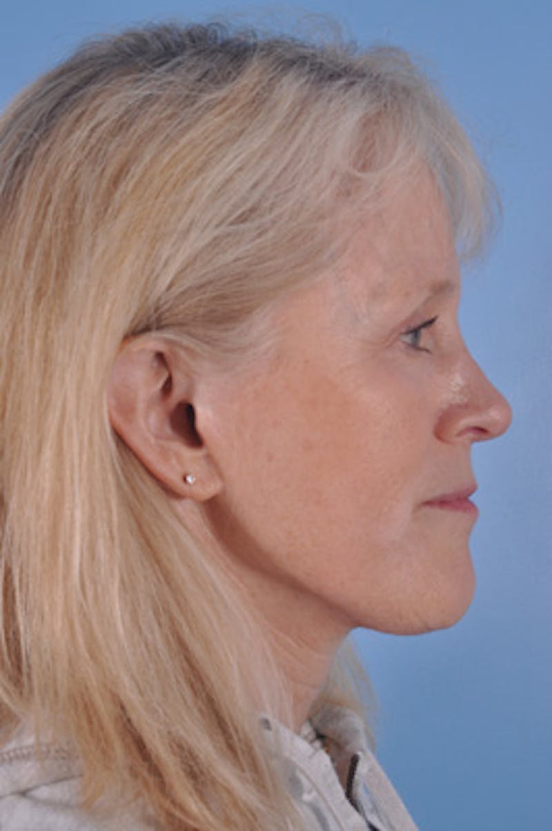 Facial Resurfacing Before & After Gallery - Patient 415319 - Image 3