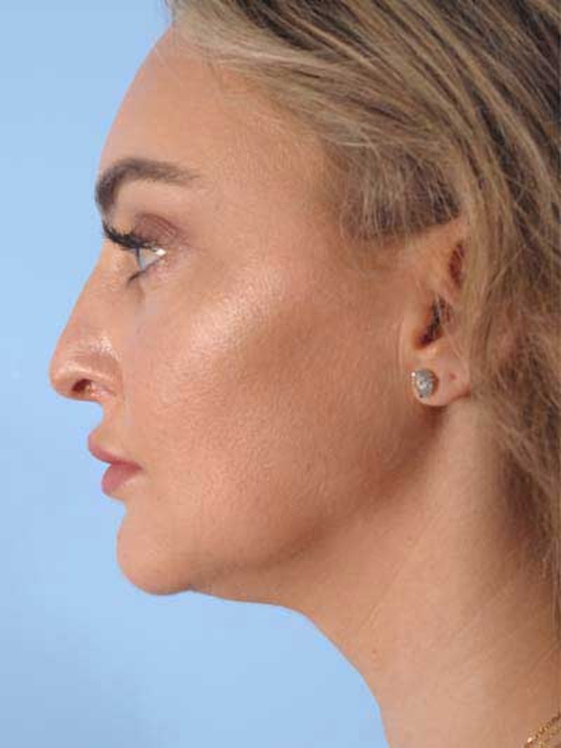 Rhinoplasty Before & After Gallery - Patient 115587 - Image 3