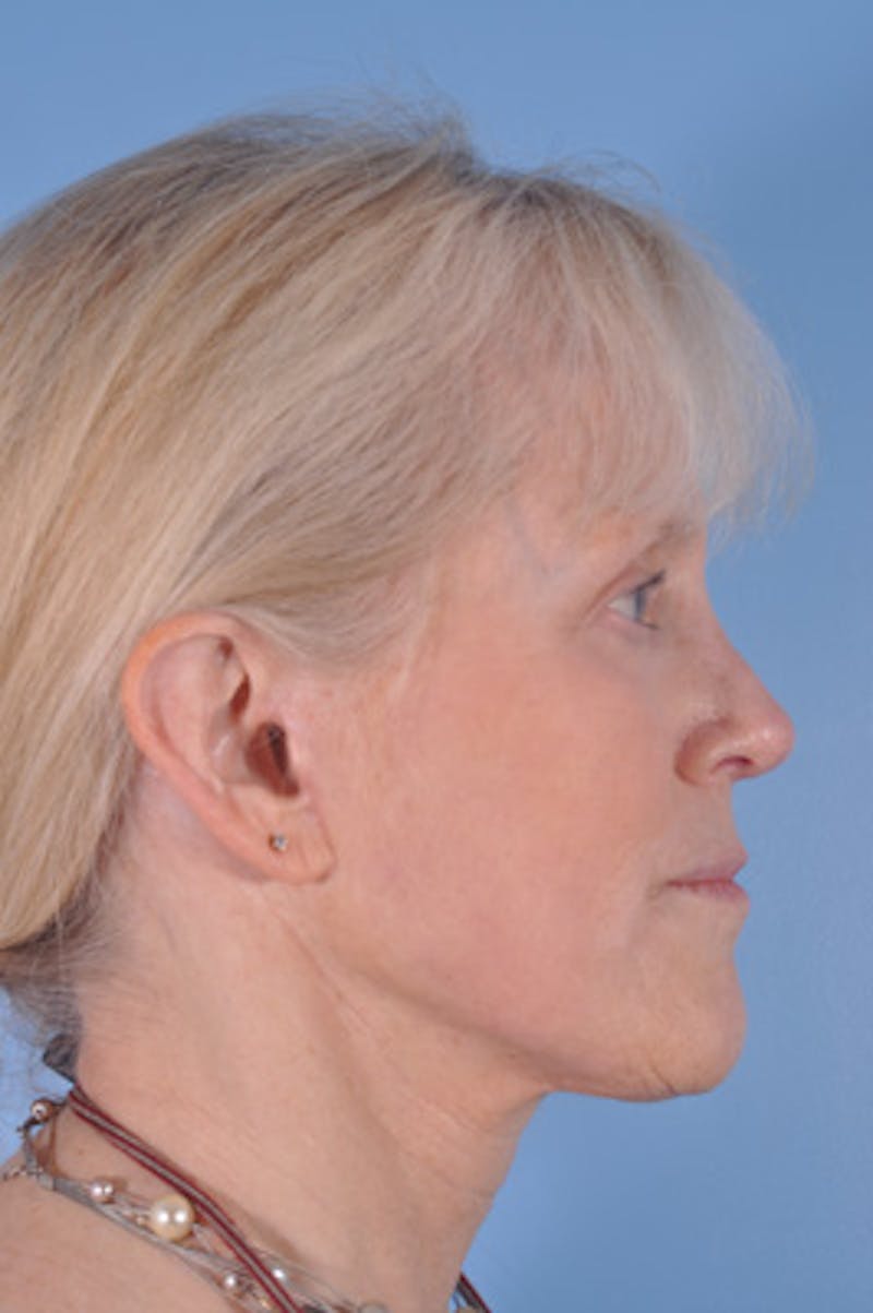 Facial Resurfacing Before & After Gallery - Patient 415319 - Image 4