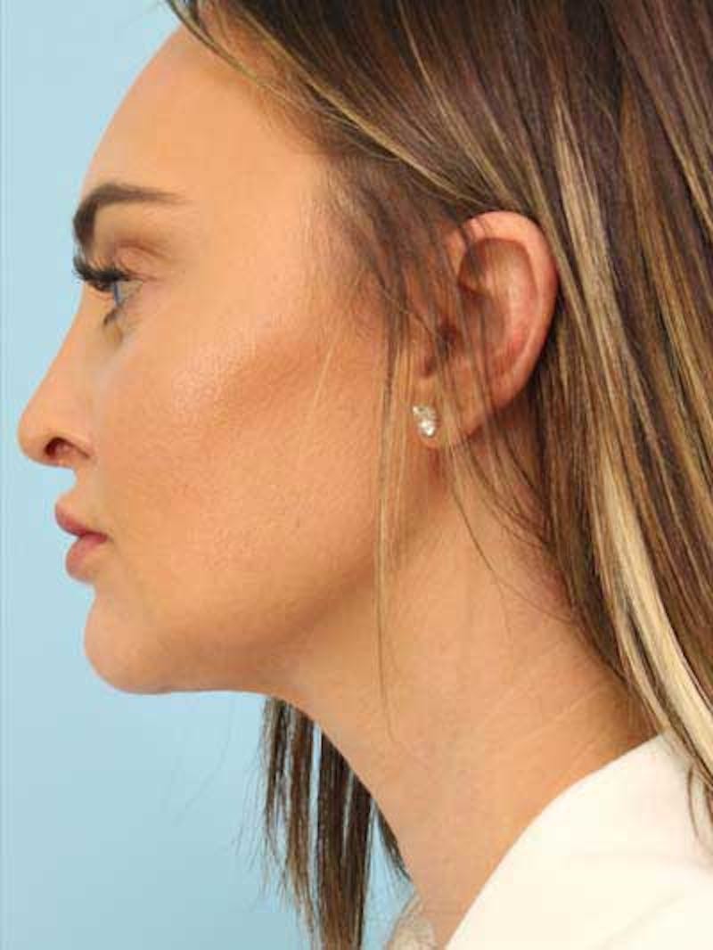 Rhinoplasty Before & After Gallery - Patient 115587 - Image 4
